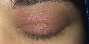 Herpes simples também pode afetar os olhos e pálpebras