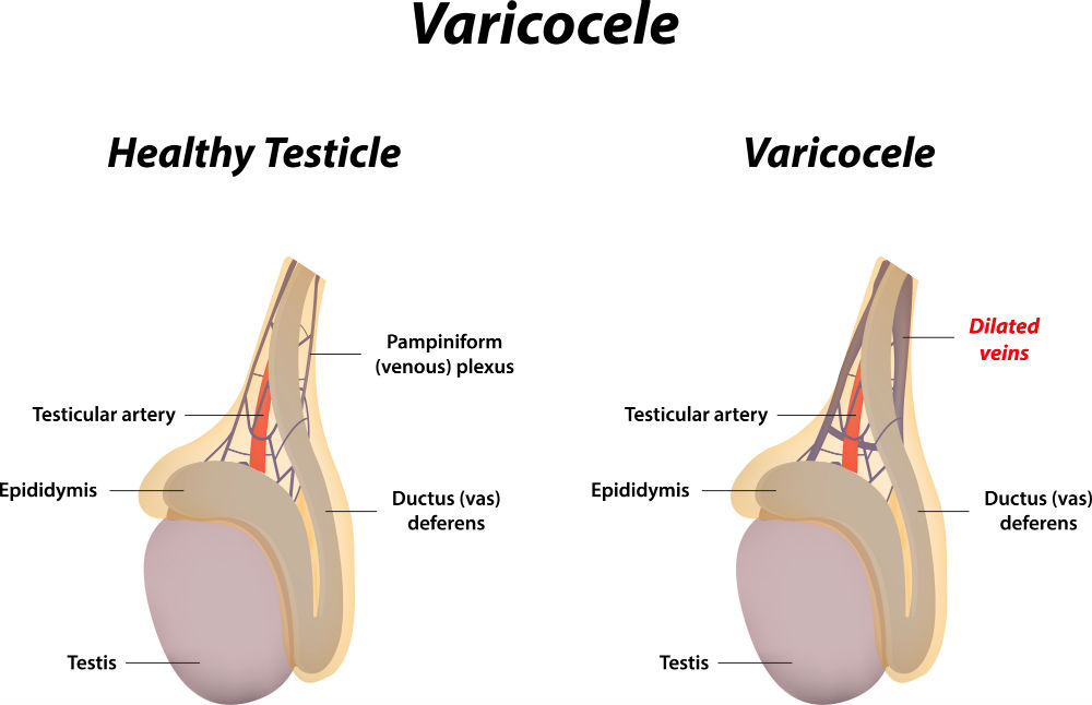 Varicocele representa 40% das causas de infertilidade masculina