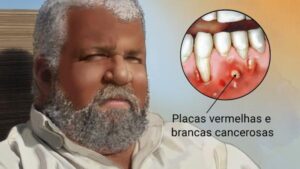 Câncer de boca: doença registra 14 mil novos casos por ano no Brasil e mata mais de 4 mil brasileiros por ano