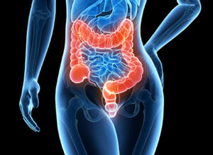 Diagnóstico precoce do câncer de intestino aumenta em 90% as chances de sobrevivência