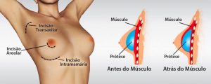 Local de implante da prótese mamária traz resultados diferentes para a cirurgia