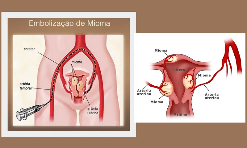 Mioma: tumor quase sempre benigno que afeta o útero mais de 5 a cada 10 mulheres em idade fértil