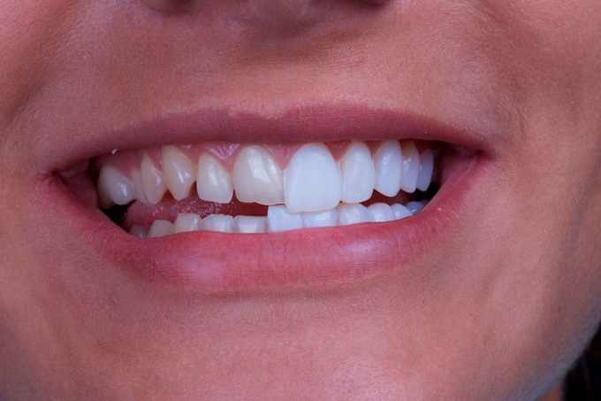 Facetas dentais: o que são e para que servem?