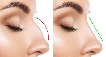 Cuidados e procedimentos antes de realizar a cirurgia no nariz