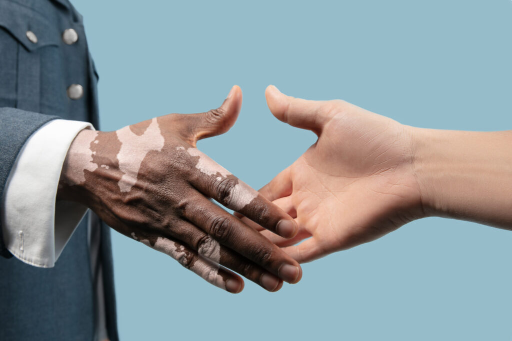 Vitiligo: uma doença ainda rodeada de desinformação e preconceito