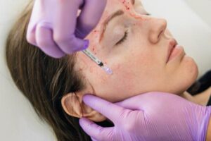 Vampire Facial: entenda o procedimento que usa o sangue do próprio paciente para rejuvenescer a pele