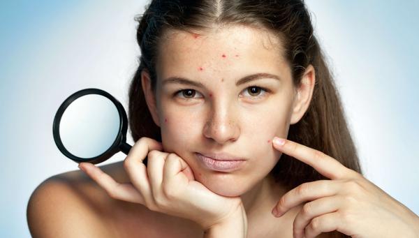 Por que ocorre e como tratar a acne no período menstrual