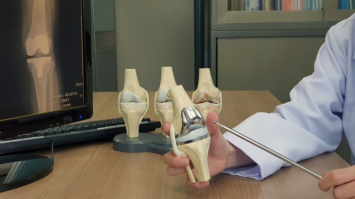 Implantes inteligentes podem ser o futuro das próteses de joelho