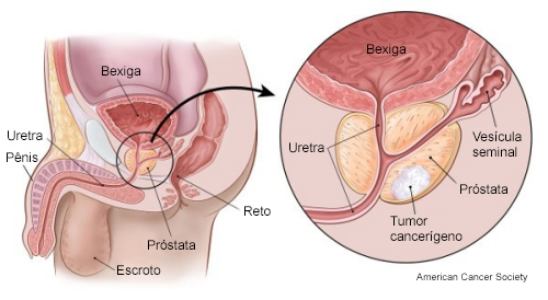 Diagnósticos de câncer de próstata, pênis e testículo têm queda preocupante em 2021 no país