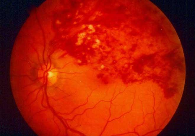 Hipertensão e diabetes são fatores de risco para trombose ocular. Saiba como identificar a doença, fortemente ligada à cegueira