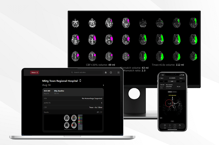 INC diminui tempo de atendimento dos casos de AVC com ajuda de Inteligência Artificial